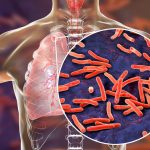 Ограничения из-за коронавируса могут привести к гибели 1,4 млн человек от туберкулеза