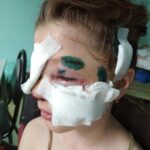 В Зубцове собака разорвала лицо 10-летней девочке
