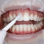 Что нужно знать о фторировании зубов