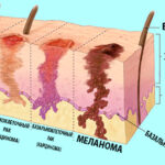 Что такое меланома кожи?