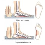 Берут ли в армию с плоскостопием