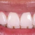 Виниры: что это, в каком случае устанавливаются