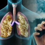 «Попкорновая болезнь» вейперов захватывает Россию — за год больных стало на 30% больше